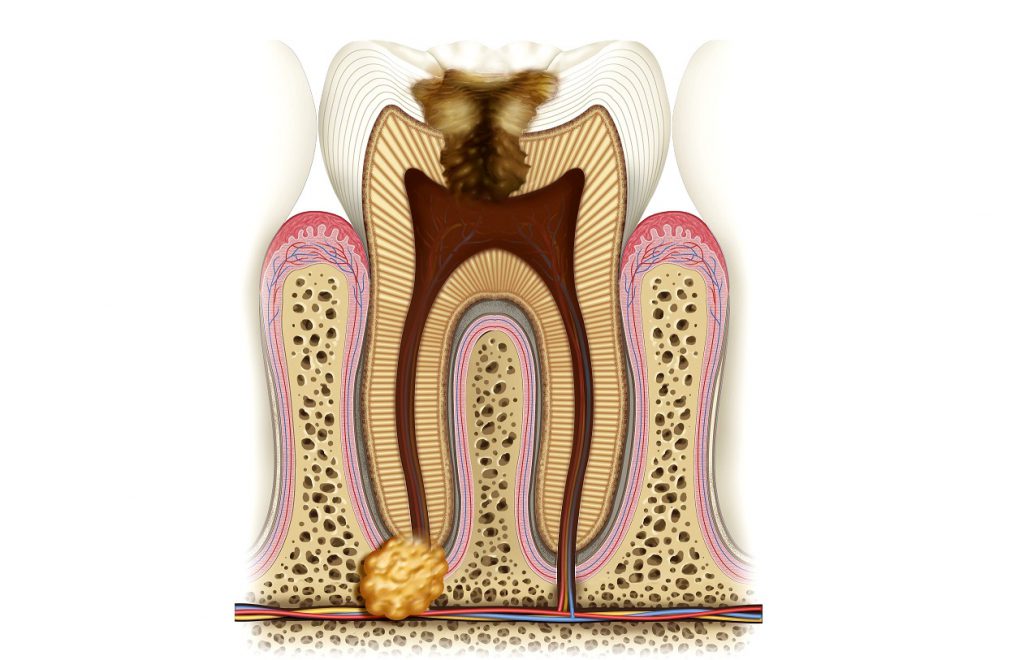 Гранулема зуба лечение в екатеринбурге